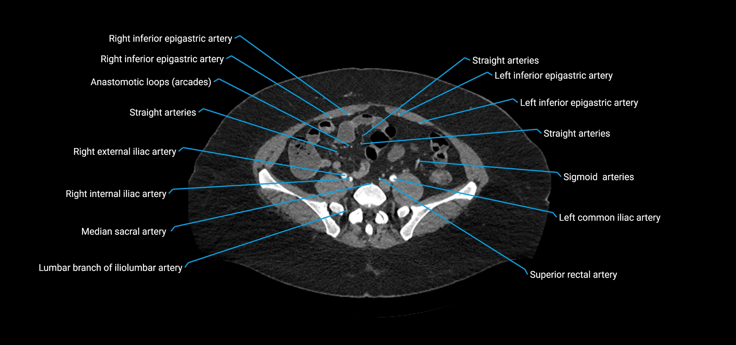 CTA abdomen axial cross sectional anatomy labelled image_171 (2).webp